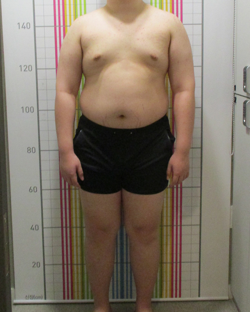 웰씬다이어트 14개월 경과 치료 전 정면