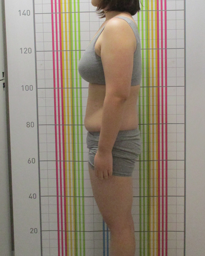 결혼준비 다이어트 클리닉 8개월 경과 치료 후 정면