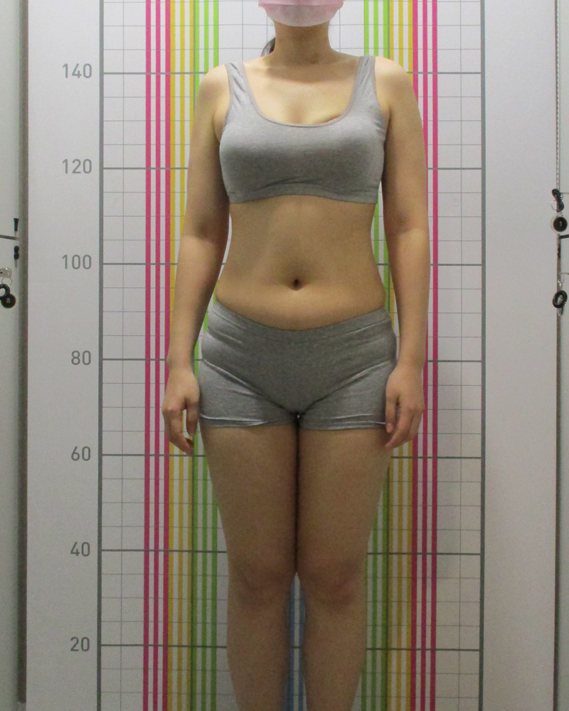 웰씬다이어트 2개월 경과 치료 전 정면