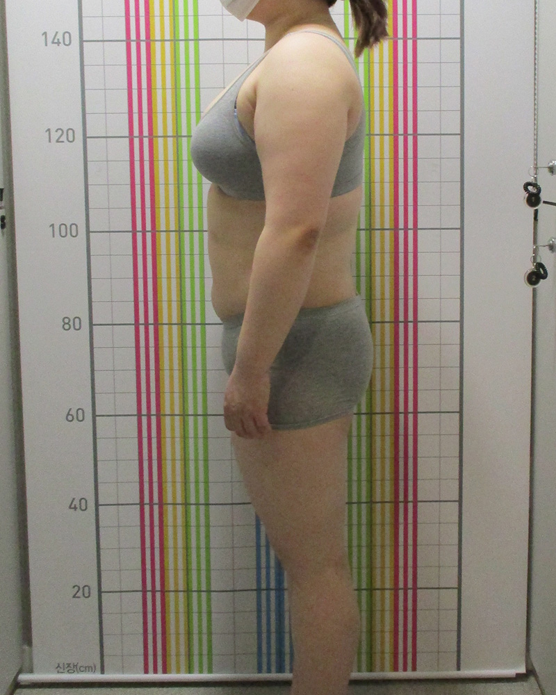 웰씬다이어트 3개월 경과 치료 전 정면