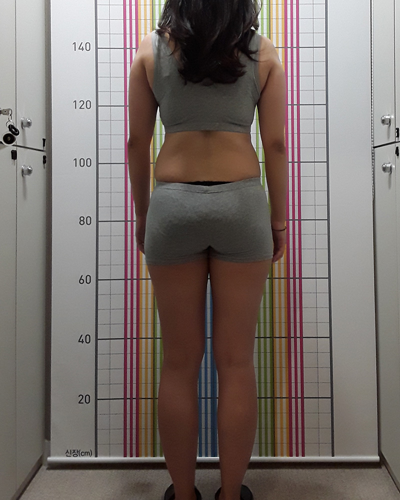 웰씬다이어트 4개월 경과 치료 전 정면
